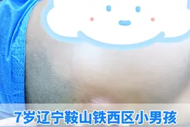 耳前瘘管肿胀的非常厉害，马上要破溃了#耳前瘘管 #抖出健康知识宝藏  #武汉陈金辉视频封面