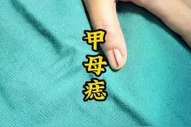 指甲长出一条黑色的，甲母痣建议切除 #甲母痣和甲黑线的区别 #甲母痣一定要切掉吗 #甲母痣怎么消除 #甲母痣 #甲母痣切除