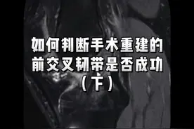 判断前交叉韧带重建手术成功与否，还要通过体格检查和影像学来评估！#科普一下 #前交叉韧带重建 #前交叉韧带损伤 #骨科医生 #医途暖光视频封面