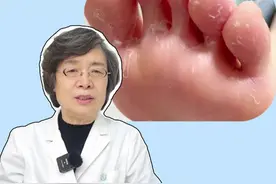 脚趾缝发白脱皮，别不当回事，这是会传染的皮肤病 ！#脚气 #传染 #科普 #健康 #咪康唑散视频封面