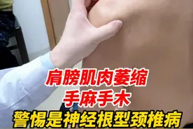 肩膀肌肉萎缩，手麻手木，警惕是神经根型颈椎病 #抖出健康知识宝藏  #肩膀没力气 #手麻 #颈椎病视频封面