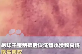 易烊千玺刮痧后误洗热水澡致高烧，医生：水湿寒邪通过开放的毛孔侵入身体，也并非越用力颜色越深越好