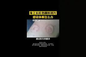 身上长圆形的红色斑片，可能是#体癣 ！千万不要用手抓，可能会传染到其他位置！#健康科普 #医学科普 视频封面
