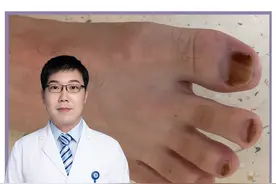 碘伏治疗灰指甲真的能行？不要再相信民间偏方了！#樊哥撩皮肤#灰指甲 #脚气 #知识分享 #dou来辟谣吧 @抖音辟谣 视频封面