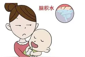 如果是新生儿出现了脑积水，一般会有哪些症状呢？#脑积水 #先天性脑积水 #父母必看系列 视频封面