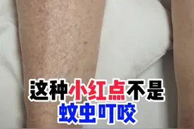 对称分布，压了不褪色的红点可能是出血点 #紫癜 #出血点 #抖出健康知识宝藏 #抖音知识年终大赏