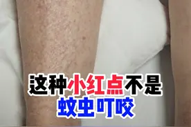 对称分布，压了不褪色的红点可能是出血点 #紫癜 #出血点 #抖出健康知识宝藏 #抖音知识年终大赏