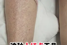 对称分布，压了不褪色的红点可能是出血点 #紫癜 #出血点 #抖出健康知识宝藏 #抖音知识年终大赏视频封面