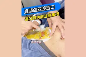 直肠癌双腔造口回纳前注意事项#胃肠健康 #胃肠专家张万福教授 #直肠癌 #造口护理 #硬核健康科普行动