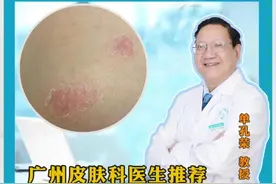 医学上为什么把牛皮癣称为银屑病 #皮肤科医生 #硬核健康科普行动 #广东银屑病医生推荐 #单孔荣医生 #挂单孔荣号视频封面