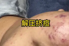 #解压 #解压挤痘 #挤痘视频封面