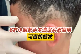 8岁小朋友手术遗留头皮疤痕，可直接植发 #头皮疤痕 #植发 #门诊案例 #医生日常 #江华医生团队视频封面