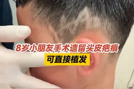 8岁小朋友手术遗留头皮疤痕，可直接植发 #头皮疤痕 #植发 #门诊案例 #医生日常 #江华医生团队视频封面