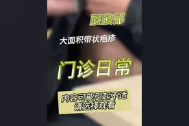 门诊日常——腰腹部大面积带状疱疹 #带状疱疹 #带状疱疹后神经痛 #抖出健康知识宝藏 #抖音知识年终大赏 #疼痛科郑拥军视频封面