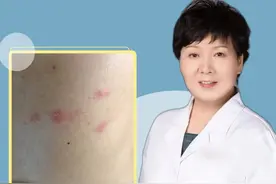 带状疱疹后遗神经痛多久能好？ #带状疱疹后神经痛视频封面