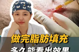 做完面部脂肪填充，多久能看到效果？ #痘坑 #填充痘坑 #痘坑手术 #八大处长心瑜 #plla视频封面