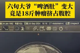 #六旬大爷啤酒肚竟是18斤肿瘤 ，医生：如果市民发现腹部在短时间内变大，需要提高警惕及时就医！#重庆广电第1眼TV