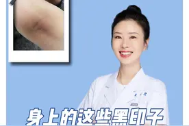 90%人身上都有的黑印子，皮肤科医生教你来处理。#黑印子 #痘印 #硬核健康科普行动视频封面
