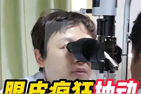 眼皮疯狂跳动，竟是梅杰综合征 #挤眉弄眼 #梅杰综合征 #痉挛 #神经异常视频封面