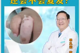 身上的白癜风治好后，白斑还会不会复发？ #广东白癜风医生推荐 #硬核健康科普行动  #单孔荣医生  #儿童白癜风  #挂单孔荣号视频封面