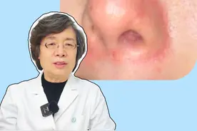 鼻翼两侧有油腻的白色皮屑，这不是没洗干净脸，当心是#脂溢性皮炎 ！#医学科普 #皮肤 #涨知识视频封面