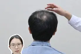 米诺地尔怎么用？这些人别滥用！看看有你吗？ #米诺地尔 #头发稀疏 #掉发 #硬核健康科普行动  #拯救发际线视频封面