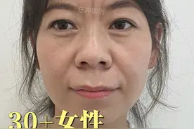 被川字纹困住的笑容和人生，终于解除“封印”了！ 以前照镜子感觉很显老，不敢照相也不敢出门，即使是出去见朋友朋友或者找工作也都不想出去，以前真是一点自信都没有、感觉生活的很压抑！ 
川字纹切除后，朋友都说做的很好，看着比以前年轻多了，精神状态好多了！
#川字纹效果太棒了 #川字纹 #川字纹任冲 #任氏川字纹切除术 #任冲拯救重度川字纹视频封面
