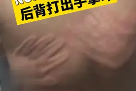 有人会铁砂掌？医生告诉你怎么一回事！#寻麻疹 #划痕症 #科普视频封面