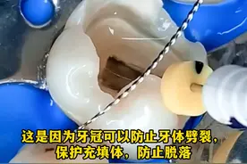 做了根管治疗后的牙齿可是很脆弱的!要是不做冠保护起来，随时都有劈裂的风险噢!#根管治疗  #囗腔健赓  #桩修复视频封面