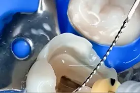 做了根管治疗后的牙齿可是很脆弱的!要是不做冠保护起来，随时都有劈裂的风险噢!#根管治疗  #囗腔健赓  #桩修复视频封面