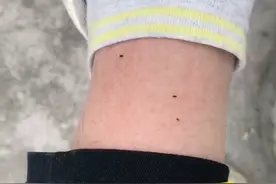 这种小黑蚊！怎么这么毒？别担心，孙医生教你正确处理~#蠓虫 #医学科普 #槟榔虫 #小咬