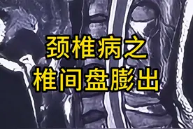 颈椎病之椎间盘膨出 #医学影像#医学生#颈椎#颈椎病#椎间盘膨出
