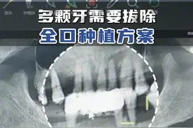 多颗牙需要拔除，全口种植方案！ #种植牙 #种牙 #知识点亮她 #抖出健康知识宝藏视频封面