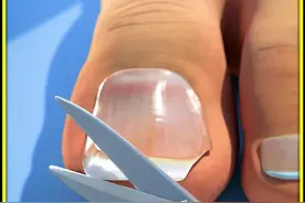你的脚趾甲为啥向内生长？如何正确的剪脚趾甲？ #知识科普视频封面