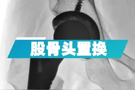 一部分艾滋病患者容易出现股骨头坏死，要注意及时就医！#骨科视频封面