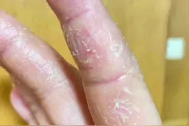 女性一只手掌干燥、脱皮、有红斑，这是一种富贵病，建议懒一点！#手癣 #女性健康 #皮肤 #医学科普 #鹅掌风