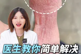 女生手上干燥起皮，这是天生“公主命”！#湿疹#家庭主妇#情侣#角化型湿疹#科普视频封面