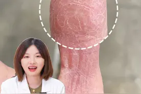 女生手上干燥起皮，这是天生“公主命”！#湿疹#家庭主妇#情侣#角化型湿疹#科普视频封面