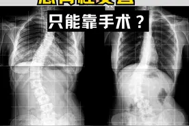 想把脊柱变直，只能靠手术？ #罗义医生 #脊柱侧弯 #硬核健康科普行动  #剃刀背 #内容启发搜索视频封面