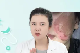 脱皮祛斑的危害 #祛斑 #黑色素提取 #淡斑 #药水点斑 #皮肤美容 @抖音短视频视频封面