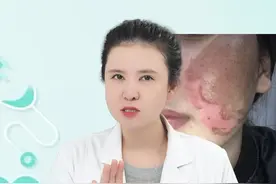 脱皮祛斑的危害 #祛斑 #黑色素提取 #淡斑 #药水点斑 #皮肤美容 @抖音短视频视频封面