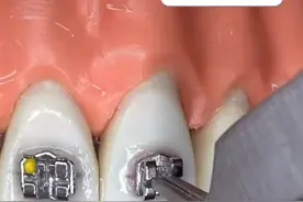 模型演示牙齿矫正是如何粘托槽的，这也意味着正畸之路的开始！ #牙齿矫正 #托槽 #正畸