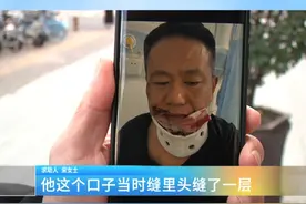 因车祸受伤，保险该怎么理赔？这里有标准！
亚太财险：按国家标准标赔付，如有异议，可提供证明 会调改金额#车祸 #保险理赔 #赔付标准视频封面