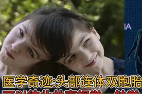 医学奇迹:头部连体双胞胎,可以彼此共享视觉、触觉视频封面