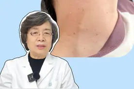 脖子上长这种小肉条，不是性病，而是#HPV 病毒感染，会传染！#丝状疣 #医学科普 #科普 #健康