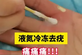 液氮冷冻去疣痛得受不了，医生教你一招无痛处理#丝状疣  #跖疣  #寻常疣 #硬核健康科普行动  #脖子上长小肉粒视频封面