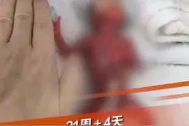 3月13日，广东深圳，超早产儿“肉肉”出院回家啦！“肉肉”出生时胎龄只有21周4天，21周超早产儿被视为人类生存极限，此前国内尚无21周超早产儿存活记录。#早产儿 #人类极限#深圳dou知道  @抖音短视频视频封面