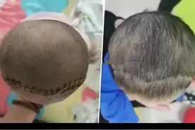 我们生活中比较常见的，大多是偏头和斜头畸形。其实短头畸形，也是婴儿头颅畸形的一种，同样也是由于某条颅缝早闭引起的疾病。#短头畸形 #冠状缝早闭 #父母必看系列视频封面