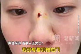 女生鼻骨骨折消肿后变高鼻梁，当事人:直接美出了一个新高度，医生：骨折处有增生使鼻梁变高视频封面