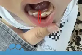7月1日报道，昆明7岁女童拔乳牙时被错拔恒牙，诊所：家长指定坚持要拔，愿走司法程序承担责任，家长报警索赔50500元，相关部门展开调查（极目新闻）#大象主播说视频封面